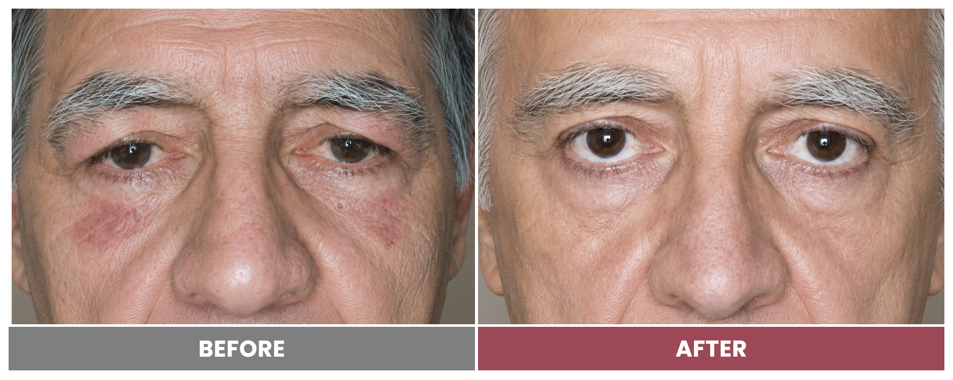 Upper Blepharoplasty - Case 72